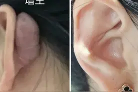 热门的肋软骨、耳软骨隆鼻，真的那么“香”吗？真相可能吓你一跳图片