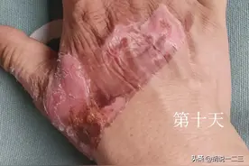 烫伤十日愈图片