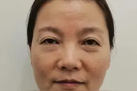 43岁做完泪沟填充7天了，想和大家说点大实话，听完再做也不迟！图片