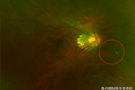得了飞蚊症不用慌，多种方式可以“消灭”它图片