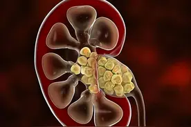 多发肾结石，小便刺痛，病在湿热下注！用金钱草组方，溶石止痛图片