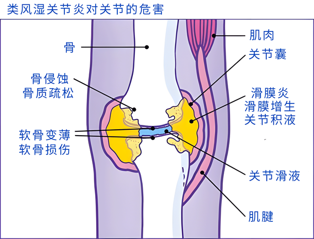 膝关节积液和哪些疾病的发生有关？医生揭晓答案
