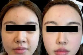 怎样可以消除皱纹图片