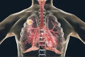 体检发现肺结节，离肺癌还有多远？医生警告：这3种结节最危险！图片