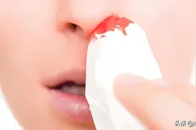 鼻子经常出血，会不会是免疫性血液病？图片