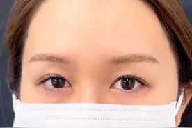陷阱！开眼角让眼睛变大？这4类人做了就是上当图片