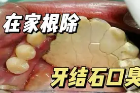 在家清除牙结石口臭！过来人的方法果真管用！后悔没早刷到！图片