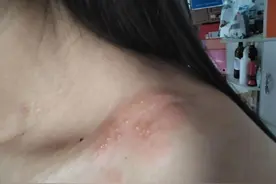 这种剧痛叫“带状疱疹”，怎么治好得快？这个方法可以帮你！图片