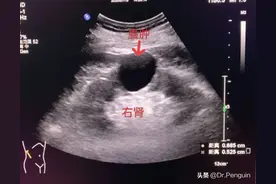 做泌尿系彩超，为什么要憋尿？图片