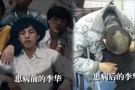 “折叠人”李华骨头被敲断4次，植入22颗钢钉，如今是什么状态？图片