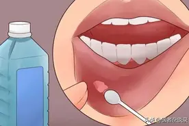 口腔溃疡反复发作，是因为缺维生素？或许还与这几个因素有关图片
