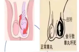 “蛋疼”要重视！睾丸疼痛不及时处理，可能出现大问题图片