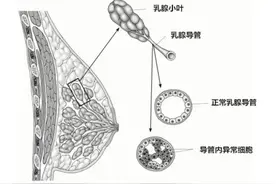 这种类型的乳腺癌规范治疗后15年生存率接近100%图片