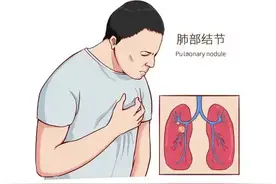 肺磨玻璃结节是啥？恶性概率+穿刺建议，一文解答！图片