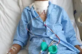 甲状腺乳头状癌淋巴转移真的不可怕吗？图片