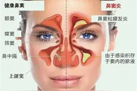 鼻窦炎手术后第二次复查图片