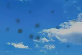 ​过度看手机致双眼玻璃体混浊来听听我的故事图片