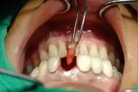 一颗坏牙一疼起来太难受？2024拔牙必看！拔牙最新价格参考图片