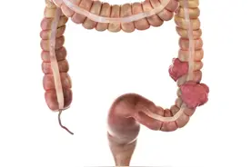 医生解剖1002例结肠癌患者，发现规律：易得结肠癌的人，有6共性图片