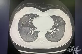 出门前喷一喷，20岁姑娘“白肺”了！这款“网红”防晒喷雾用不好很伤人图片