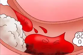 血液通畅是人最大的福气！4张中医方，化瘀血消百病！图片