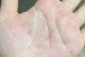 汗疱疹反复发作瘙痒难忍？中医内外兼调，教你告别“小水疱”困扰图片
