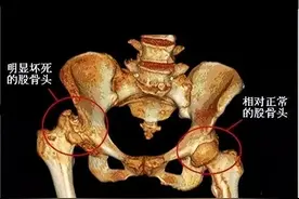 单侧早期股骨头坏死，做好这几件事，可有效防止病情加重！图片
