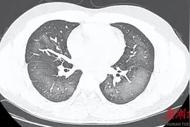 怼脸喷，7岁女孩的肺几乎全白了！图片