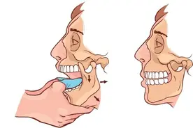 惊！笑掉下巴原来并非开玩笑……如何拯救下巴脱臼？图片