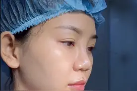 河北姑娘天生蒜头鼻、鼻翼肥厚，整形后即刻后照镜子：不敢信！图片