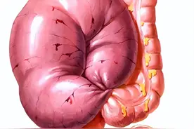 初三男孩体育课后突腹痛，居然是肠子“打了结”图片