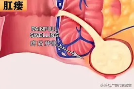 若出现这几个症状，怕是患上"肛瘘"?图片