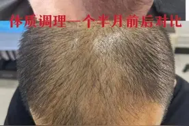 发际线后移、头发稀疏？滋阴清热祛湿，一个月发际线前移、发浓密图片
