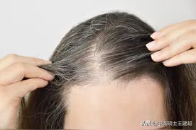 血热脱发多，血浊头发油，血虚头皮痒，3个中成药养好头发！图片