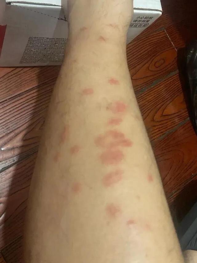 比蚊子还毒！被咬后奇痒无比，长时间难以消退！多人中招