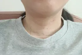 甲状腺穿刺后，纠结选择哪位医生主刀，拖到两个月之后才做手术图片