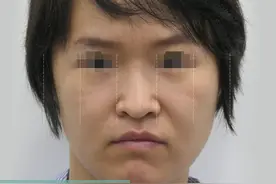 29岁想变好看，花大几万做鼻子、填鼻基底，4个月惊艳身边朋友！图片