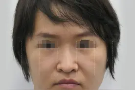 29岁想变好看，花大几万做鼻子、填鼻基底，4个月惊艳身边朋友！图片