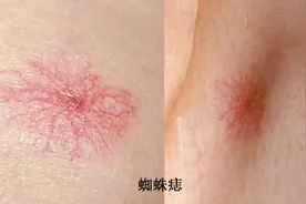 身上这种小红点，别以为是过敏，很可能是“肝脏预警”！图片