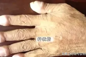 双手出现这两种症状，或是肺病前兆，千万不要大意！图片