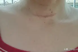 门特怎么办理？甲状腺癌术后的定期复查可以省不少钱图片