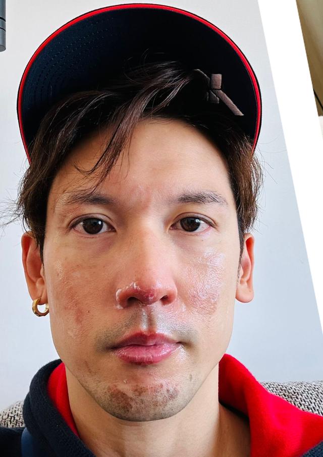 关智斌自曝煤气意外漏气致面部二级烧伤，公开康复期照片惹人心疼