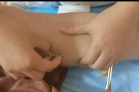 【中山医“声”】中风后遗症的新“解法”，浮针治疗了解一下图片