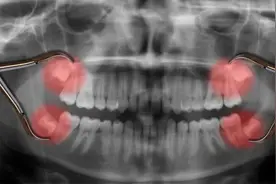 智齿出现这 6 种情况，疼不疼都得拔！否则...图片