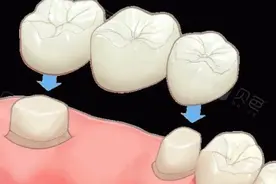 带牙冠的牙后期疼痛怎么回事图片