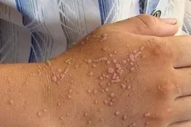 手臂变化要警惕！告诫：手臂有这3个异常要留心，或是HPV图片