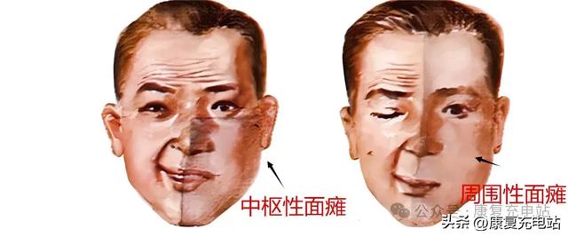 中枢性面瘫和周围性面瘫区分思路