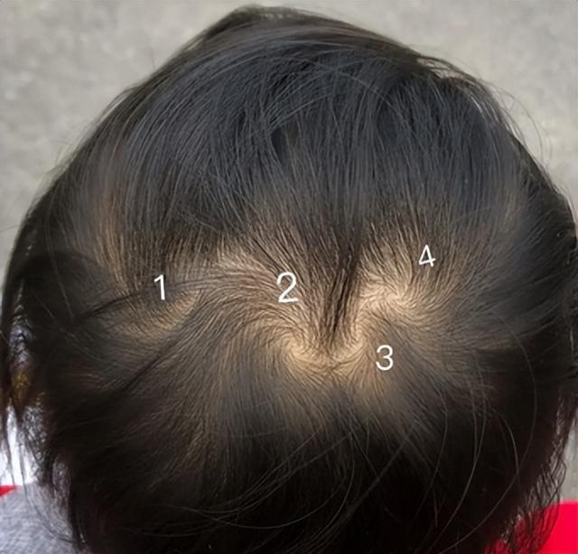 孩子头顶“2个旋”，到底代表什么？父母别不在意，看完涨知识了