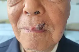 一颗“痣”越长越大居然是肿物？83岁老人成功摆脱口腔基底细胞癌图片