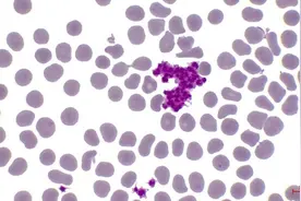 血常规这三项不达标，可能是癌症的“预警信号”图片